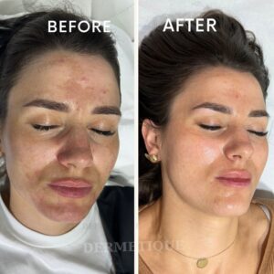 Rezultate - Clinica de înfrumusețare DERMETIQUE