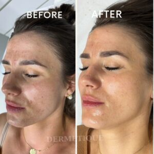 Rezultate - Clinica de înfrumusețare DERMETIQUE