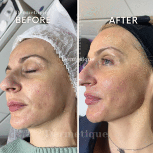 Rezultate - Clinica de înfrumusețare DERMETIQUE