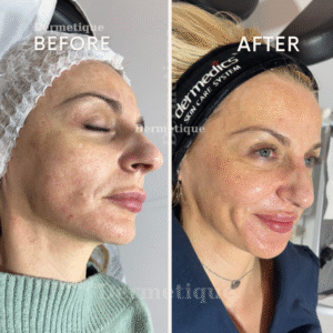 Rezultate - Clinica de înfrumusețare DERMETIQUE